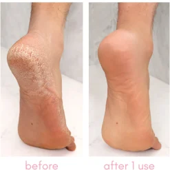 Heel-ing Callus Remover Kit